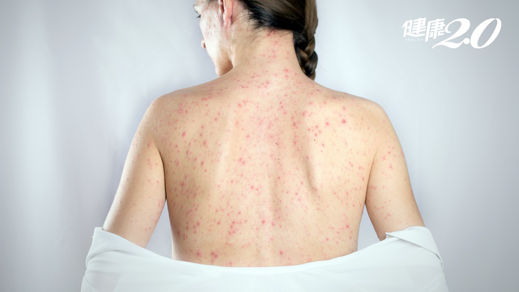 22歲女大生打3劑新冠疫苗 引發嚴重藥疹！免疫抑制劑挽救皮膚生機
