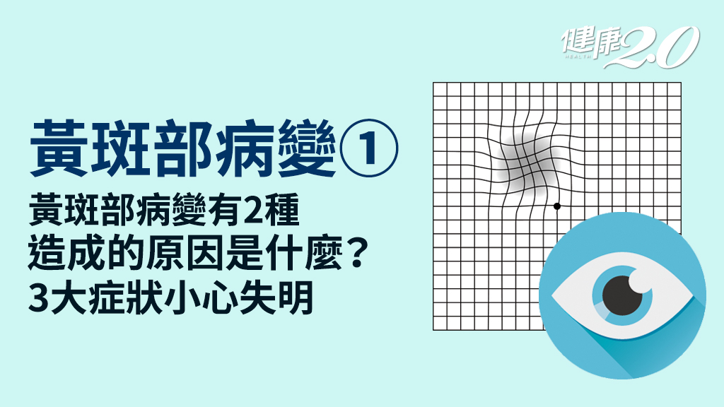 黃斑部病變／失明原因第1名！黃斑部病變有分乾、濕 症狀原因一次搞清楚
