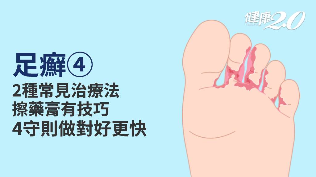 足癬／治療方法有哪些？擦藥多久才會好？擦完藥「少做一件事」小心交叉感染