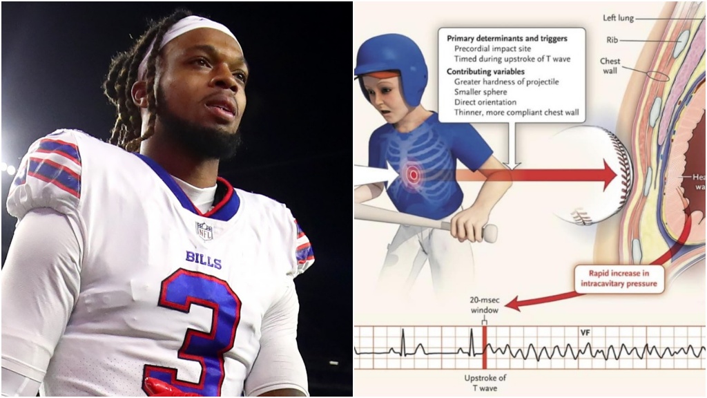 被撞到「死穴」<span style="color:#1BA42B;">美式</span>足球員心臟停止！不是武俠小說裡的神話 權威名醫：真有死穴！