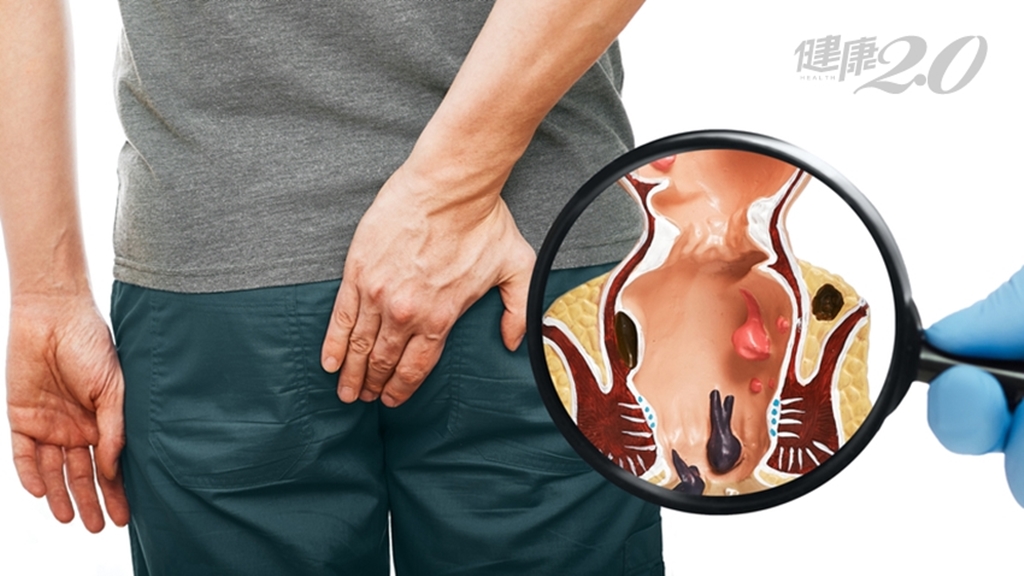 他騎腳踏車竟害痔瘡掉出肛門險破裂！痔瘡一直發炎會感染致死嗎？2招<span style="color:#1BA42B;">防痔瘡</span>