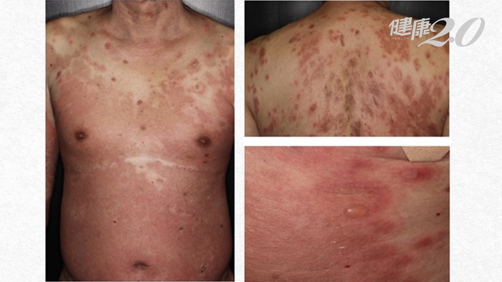 69歲男吃降血糖藥皮膚起紅疹、水泡！竟是「類天疱瘡」 糖尿病這款藥提高2倍風險