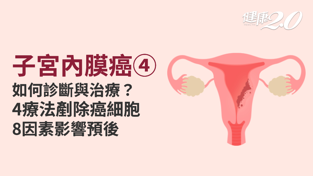 子宮內膜癌／4種治療方式，腫瘤過大也能治！常見復發部位是這裡 8因素影響預後